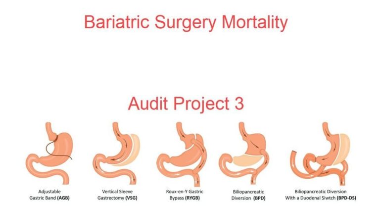 Bariatric Surgery Mortality RESEARCH AND AUDIT, NEW